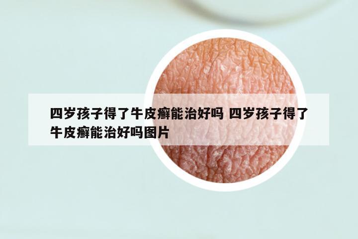 四岁孩子得了牛皮癣能治好吗 四岁孩子得了牛皮癣能治好吗图片