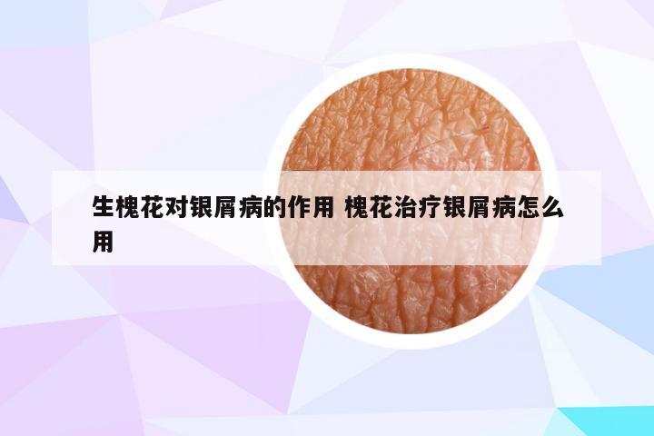 生槐花对银屑病的作用 槐花治疗银屑病怎么用