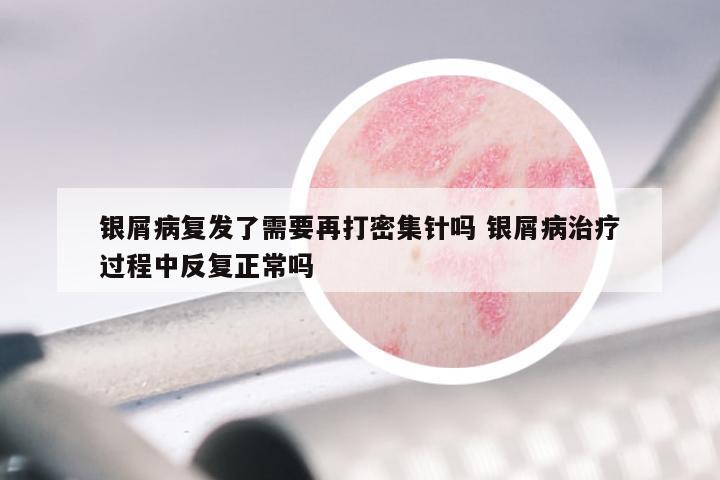 银屑病复发了需要再打密集针吗 银屑病治疗过程中反复正常吗