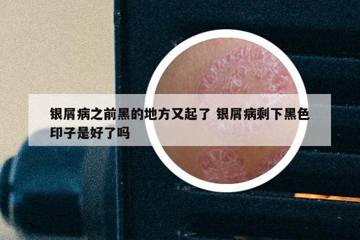 银屑病之前黑的地方又起了 银屑病剩下黑色印子是好了吗