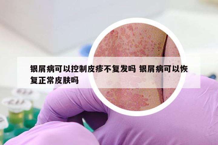 银屑病可以控制皮疹不复发吗 银屑病可以恢复正常皮肤吗