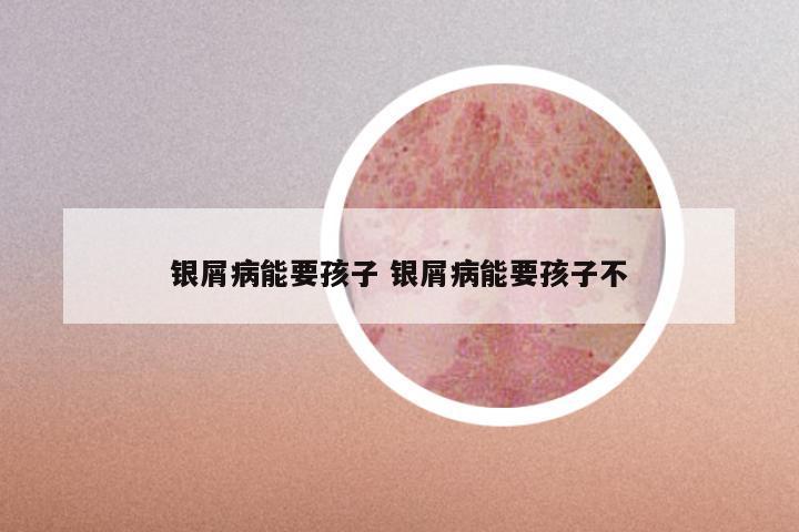 银屑病能要孩子 银屑病能要孩子不