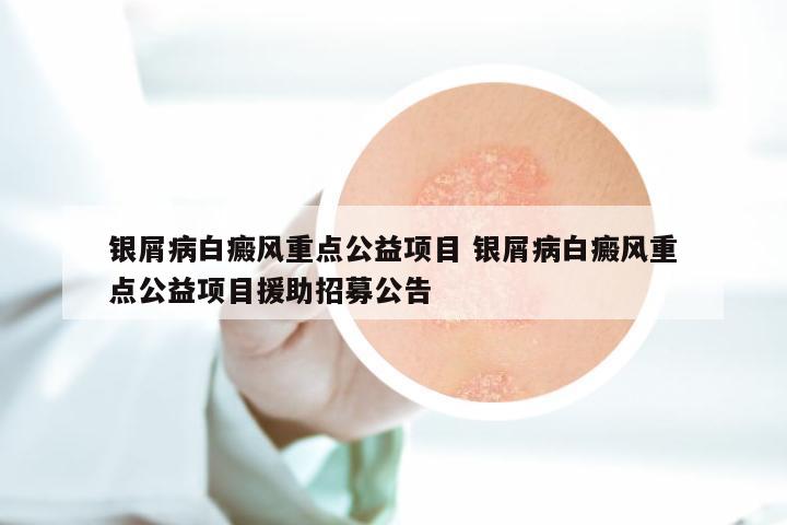 银屑病白癜风重点公益项目 银屑病白癜风重点公益项目援助招募公告