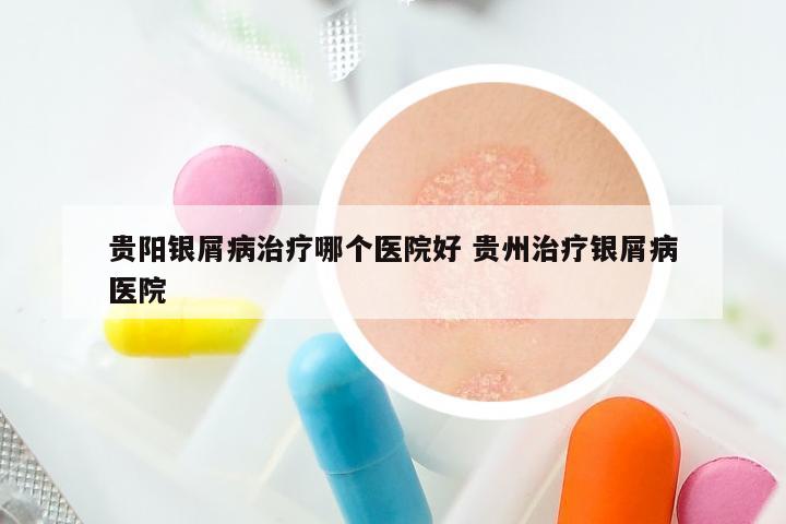 贵阳银屑病治疗哪个医院好 贵州治疗银屑病医院