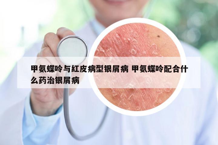 甲氨蝶呤与红皮病型银屑病 甲氨蝶呤配合什么药治银屑病