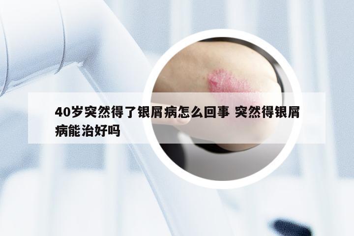 40岁突然得了银屑病怎么回事 突然得银屑病能治好吗