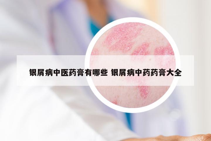 银屑病中医药膏有哪些 银屑病中药药膏大全