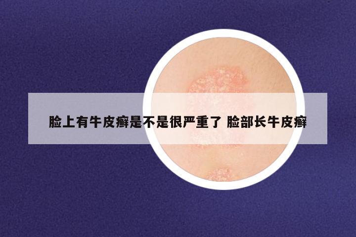 脸上有牛皮癣是不是很严重了 脸部长牛皮癣