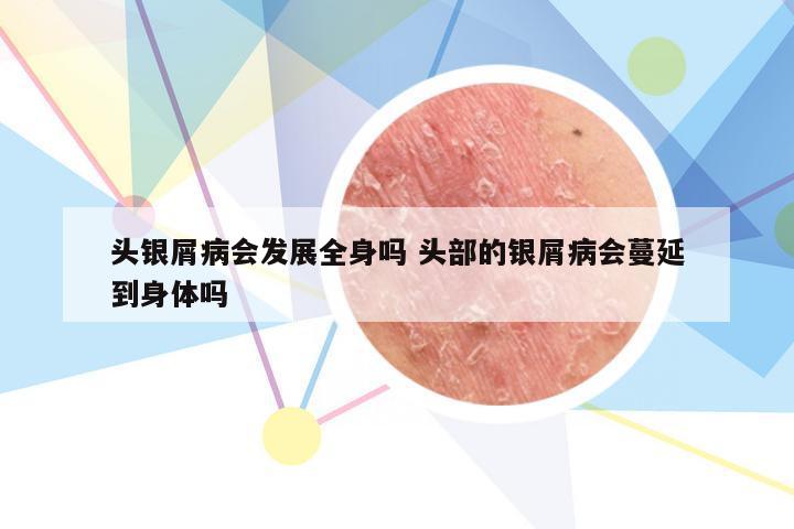 头银屑病会发展全身吗 头部的银屑病会蔓延到身体吗