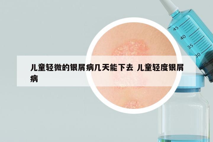 儿童轻微的银屑病几天能下去 儿童轻度银屑病