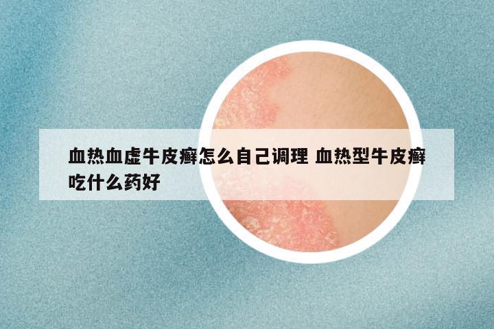 血热血虚牛皮癣怎么自己调理 血热型牛皮癣吃什么药好