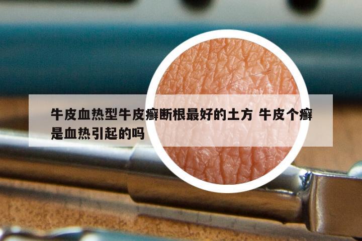 牛皮血热型牛皮癣断根最好的土方 牛皮个癣是血热引起的吗