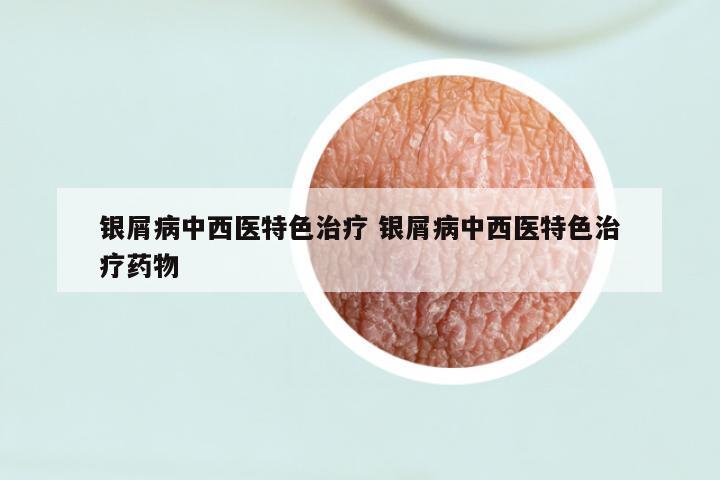 银屑病中西医特色治疗 银屑病中西医特色治疗药物