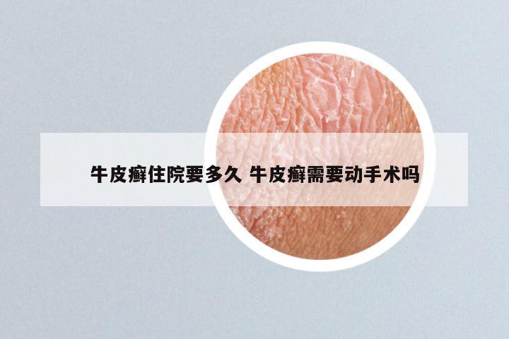 牛皮癣住院要多久 牛皮癣需要动手术吗