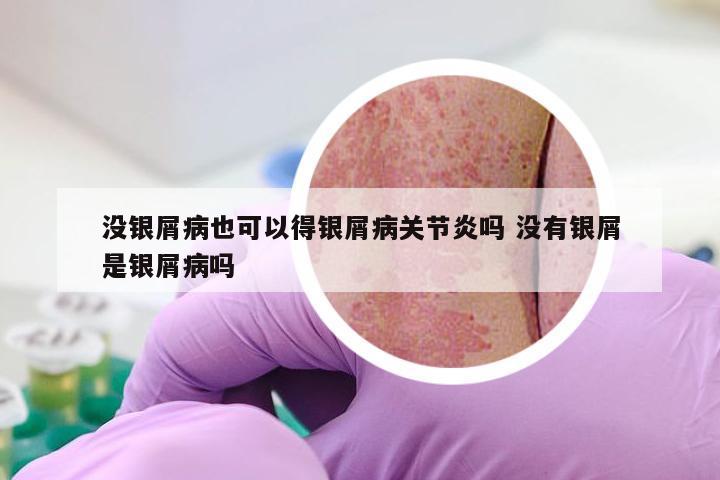 没银屑病也可以得银屑病关节炎吗 没有银屑是银屑病吗