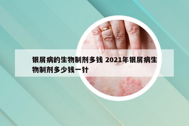 银屑病的生物制剂多钱 2021年银屑病生物制剂多少钱一针