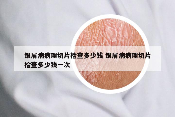 银屑病病理切片检查多少钱 银屑病病理切片检查多少钱一次