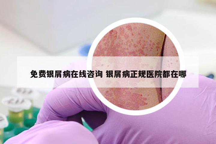 免费银屑病在线咨询 银屑病正规医院都在哪