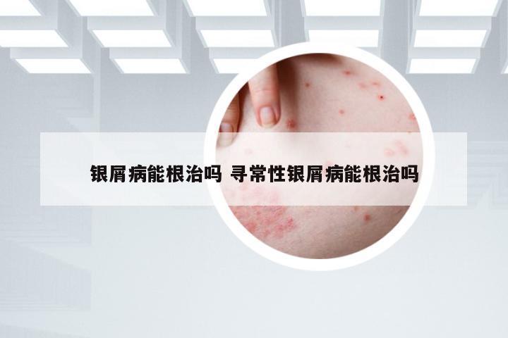 银屑病能根治吗 寻常性银屑病能根治吗