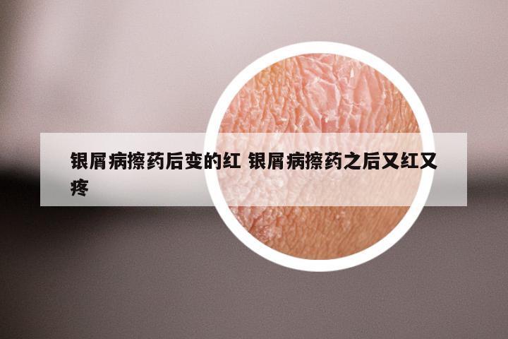 银屑病擦药后变的红 银屑病擦药之后又红又疼