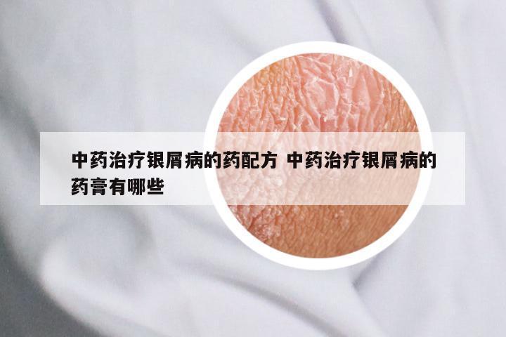 中药治疗银屑病的药配方 中药治疗银屑病的药膏有哪些