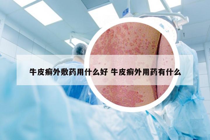 牛皮癣外敷药用什么好 牛皮癣外用药有什么