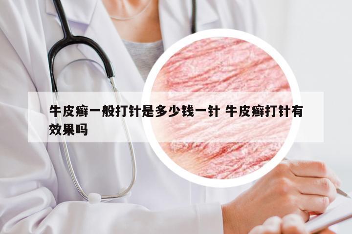 牛皮癣一般打针是多少钱一针 牛皮癣打针有效果吗
