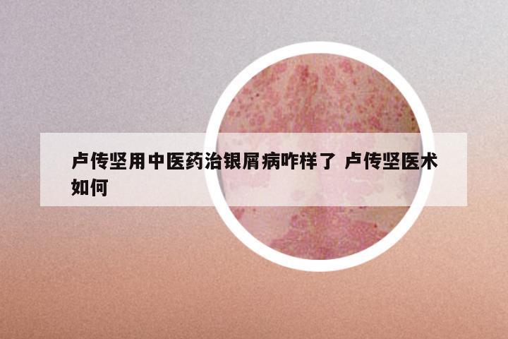 卢传坚用中医药治银屑病咋样了 卢传坚医术如何