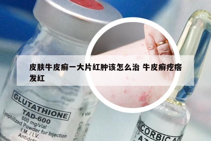皮肤牛皮癣一大片红肿该怎么治 牛皮癣疙瘩发红