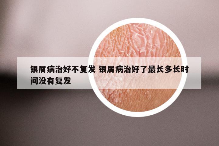 银屑病治好不复发 银屑病治好了最长多长时间没有复发