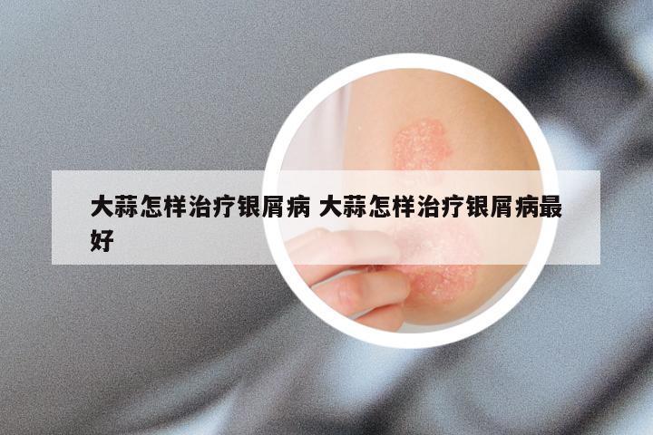 大蒜怎样治疗银屑病 大蒜怎样治疗银屑病最好