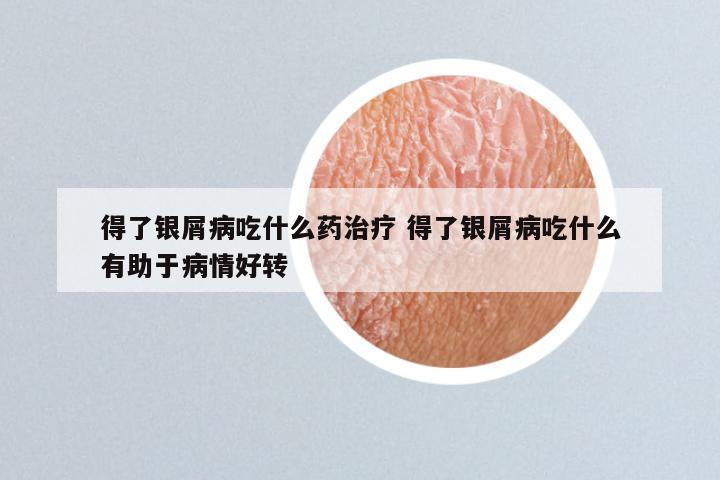 得了银屑病吃什么药治疗 得了银屑病吃什么有助于病情好转