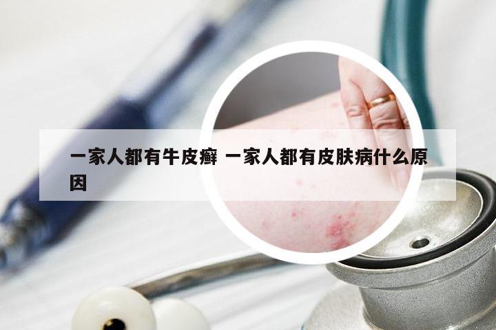 一家人都有牛皮癣 一家人都有皮肤病什么原因