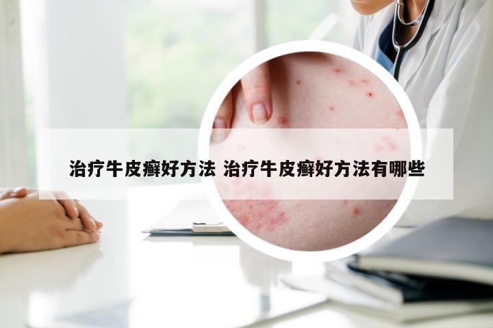 治疗牛皮癣好方法 治疗牛皮癣好方法有哪些