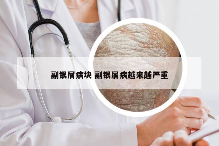 副银屑病块 副银屑病越来越严重