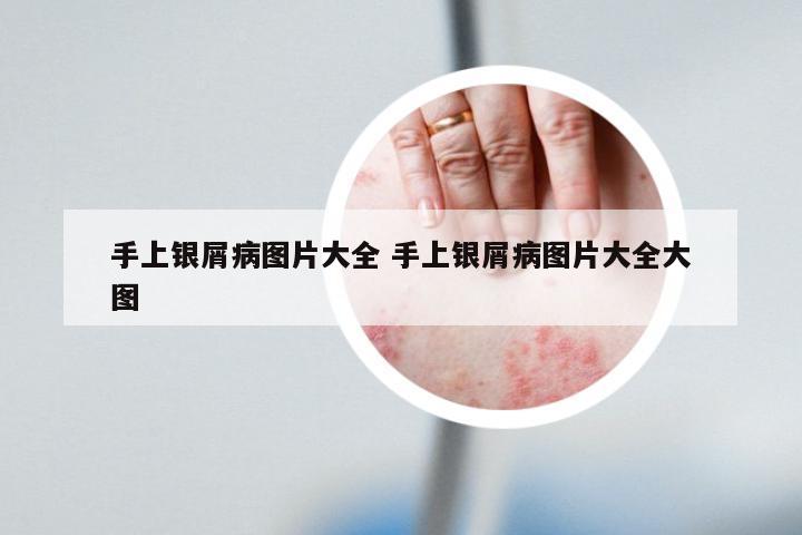 手上银屑病图片大全 手上银屑病图片大全大图