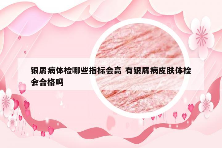 银屑病体检哪些指标会高 有银屑病皮肤体检会合格吗