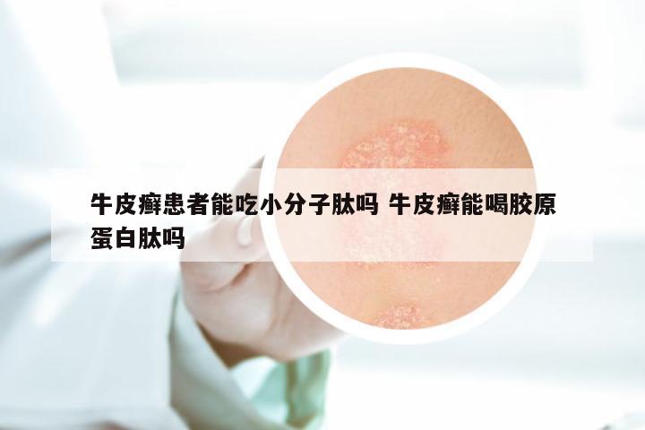 牛皮癣患者能吃小分子肽吗 牛皮癣能喝胶原蛋白肽吗