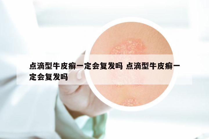 点滴型牛皮癣一定会复发吗 点滴型牛皮癣一定会复发吗