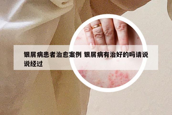 银屑病患者治愈案例 银屑病有治好的吗请说说经过