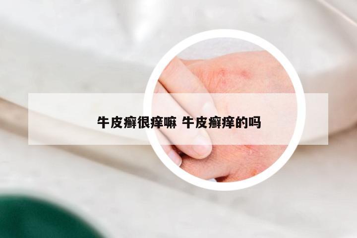 牛皮癣很痒嘛 牛皮癣痒的吗