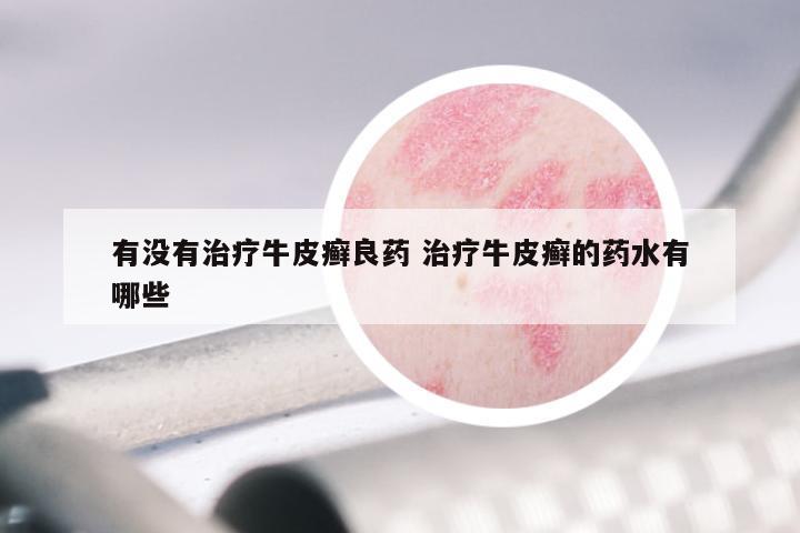有没有治疗牛皮癣良药 治疗牛皮癣的药水有哪些
