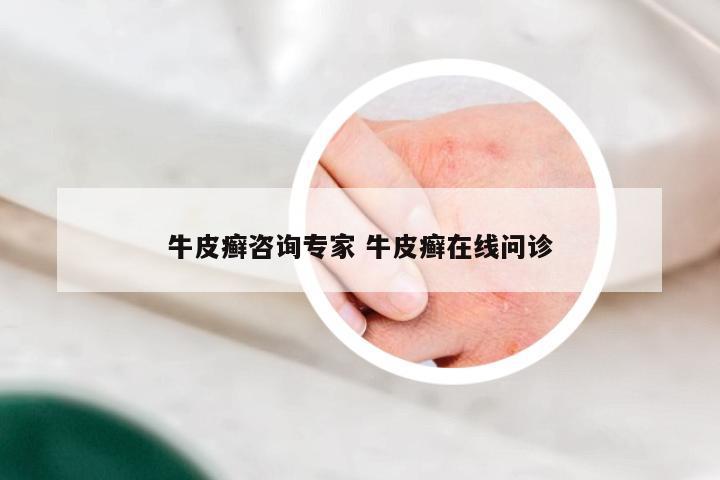 牛皮癣咨询专家 牛皮癣在线问诊