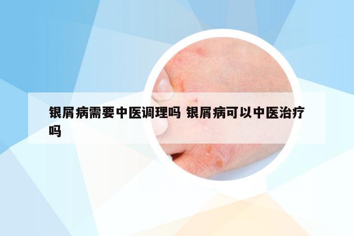 银屑病需要中医调理吗 银屑病可以中医治疗吗