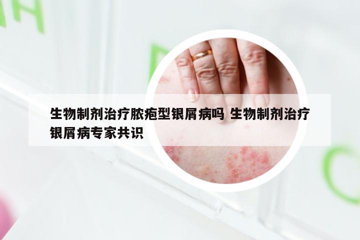 生物制剂治疗脓疱型银屑病吗 生物制剂治疗银屑病专家共识