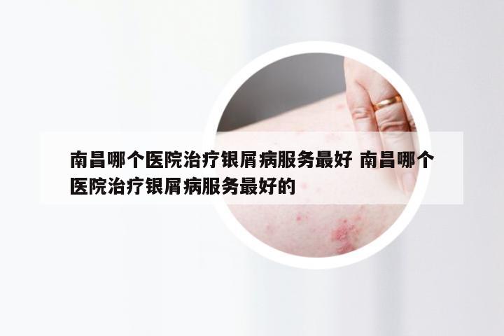 南昌哪个医院治疗银屑病服务最好 南昌哪个医院治疗银屑病服务最好的