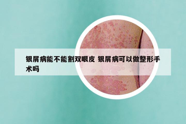 银屑病能不能割双眼皮 银屑病可以做整形手术吗