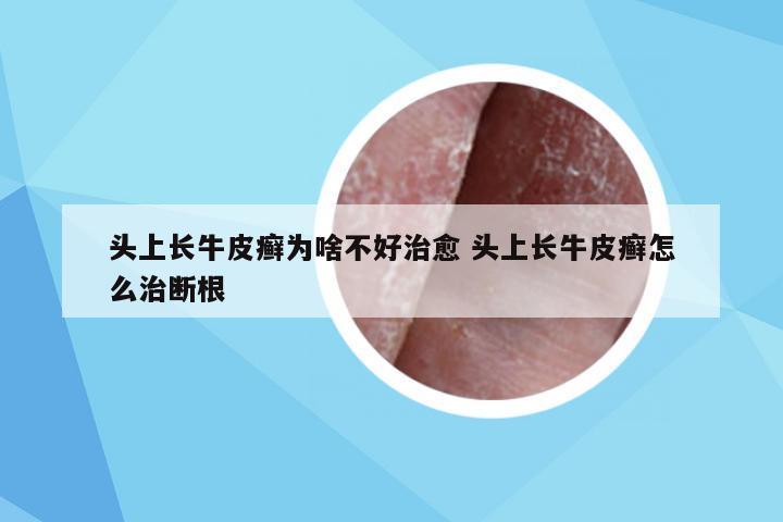 头上长牛皮癣为啥不好治愈 头上长牛皮癣怎么治断根