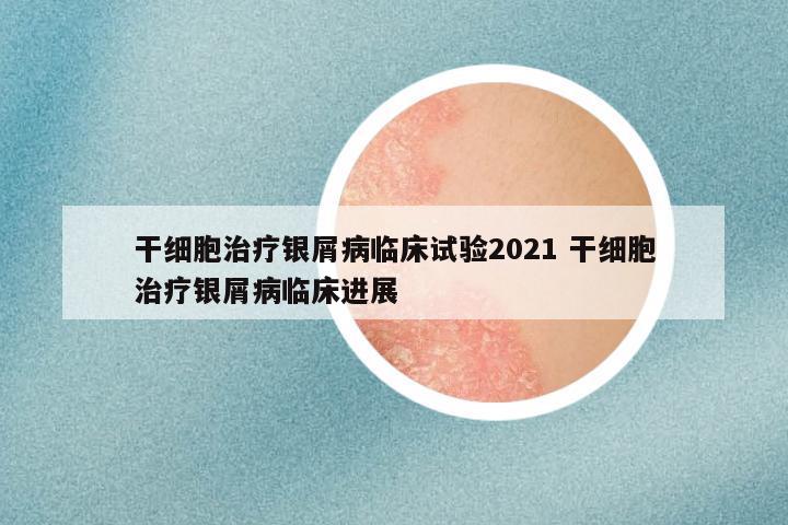 干细胞治疗银屑病临床试验2021 干细胞治疗银屑病临床进展