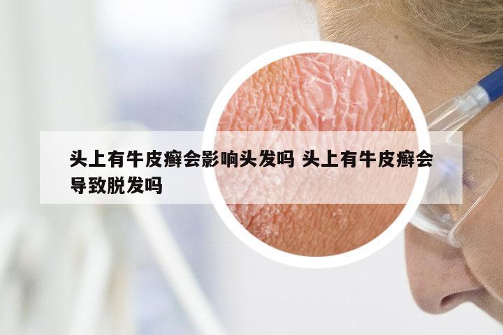头上有牛皮癣会影响头发吗 头上有牛皮癣会导致脱发吗